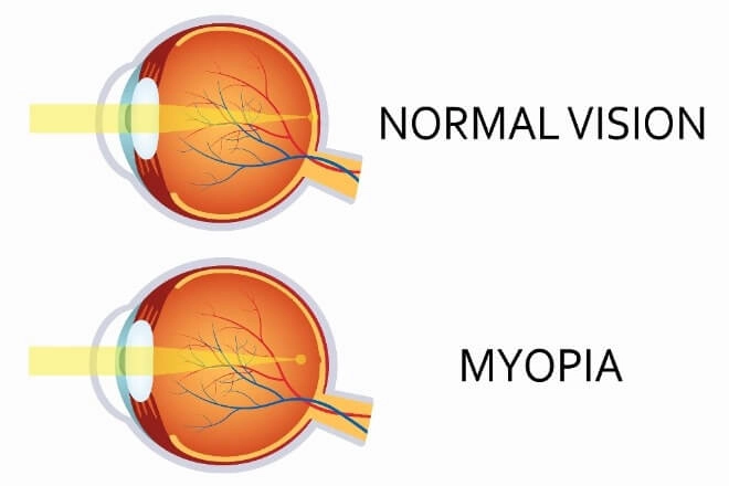 Uzroci miopije | Bio Rama DOBROBITI RUPIČASTIH NAOČALA