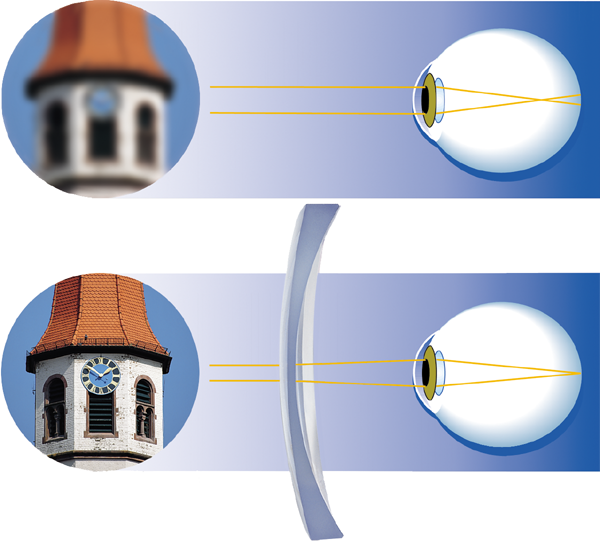 opticalbasics optics eye ametropic eye myopic with | Bio Rama DOBROBITI RUPIČASTIH NAOČALA