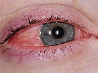 Alergije oka | Bio Rama Kako se na prirodan način zaštiti od komaraca (Recepti)