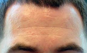 Horizontal lines on forehead