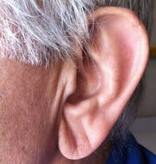 ear lobe crease