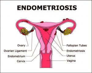 Simptomi endometrioze